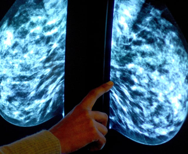 Tens of thousands of Devon women miss “vital” breast cancer screenings